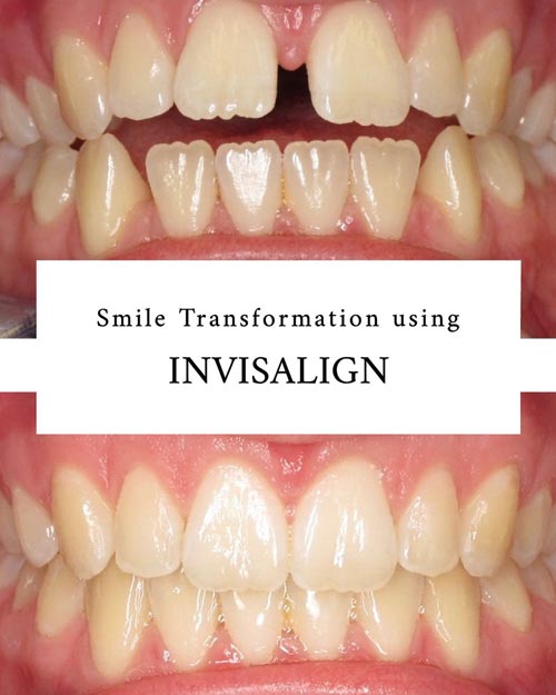 Smile transformation using Invisalign - picture 1