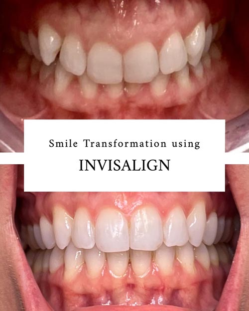 Smile transformation using Invisalign - picture 2